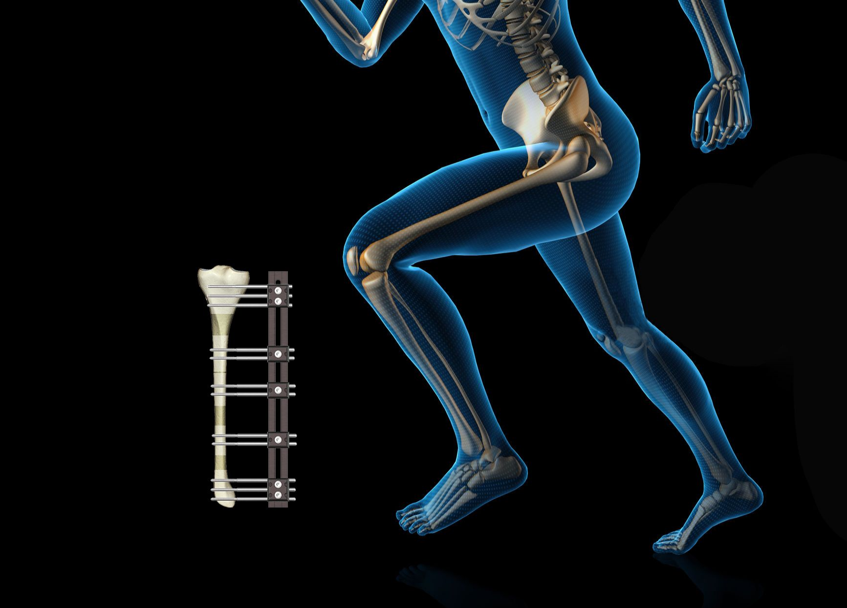 康菲斯肢体重建外固定支架_单臂式骨科外固定支架